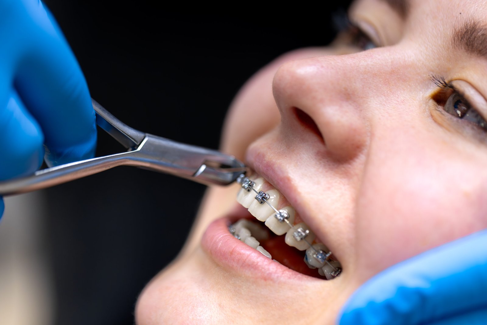 Dental procedure for installing braces close up. Dentistry. Braces on the teeth.