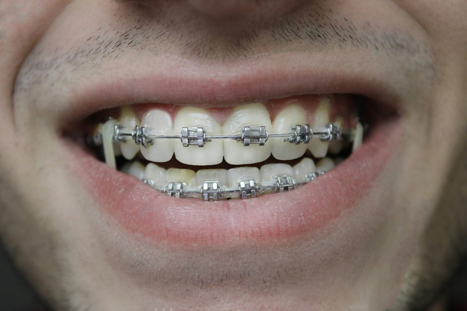 braces-4